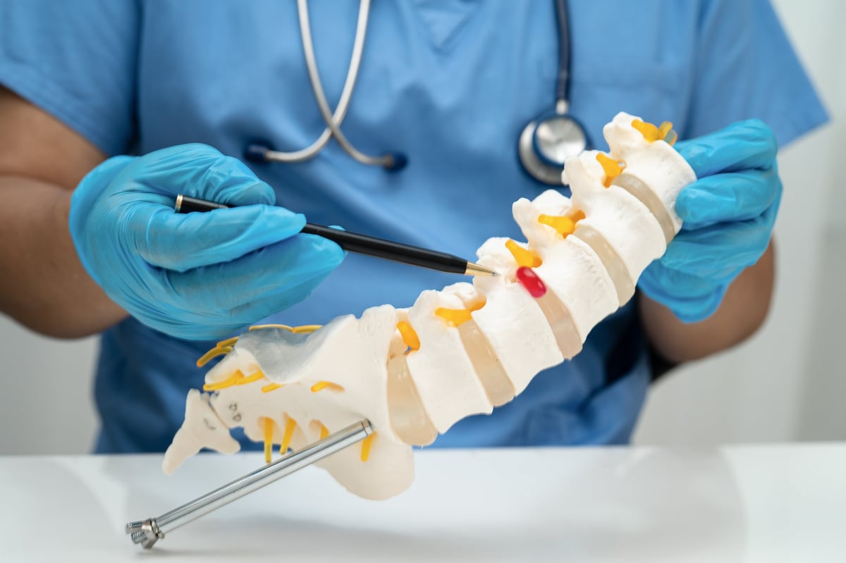 Asian doctor holding spinal nerve and bone model, Lumbar spine displaced herniated disc fragment for treatment medical in the orthopedic department.